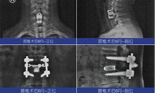 腰椎钛合金_椎间盘钛合金价格